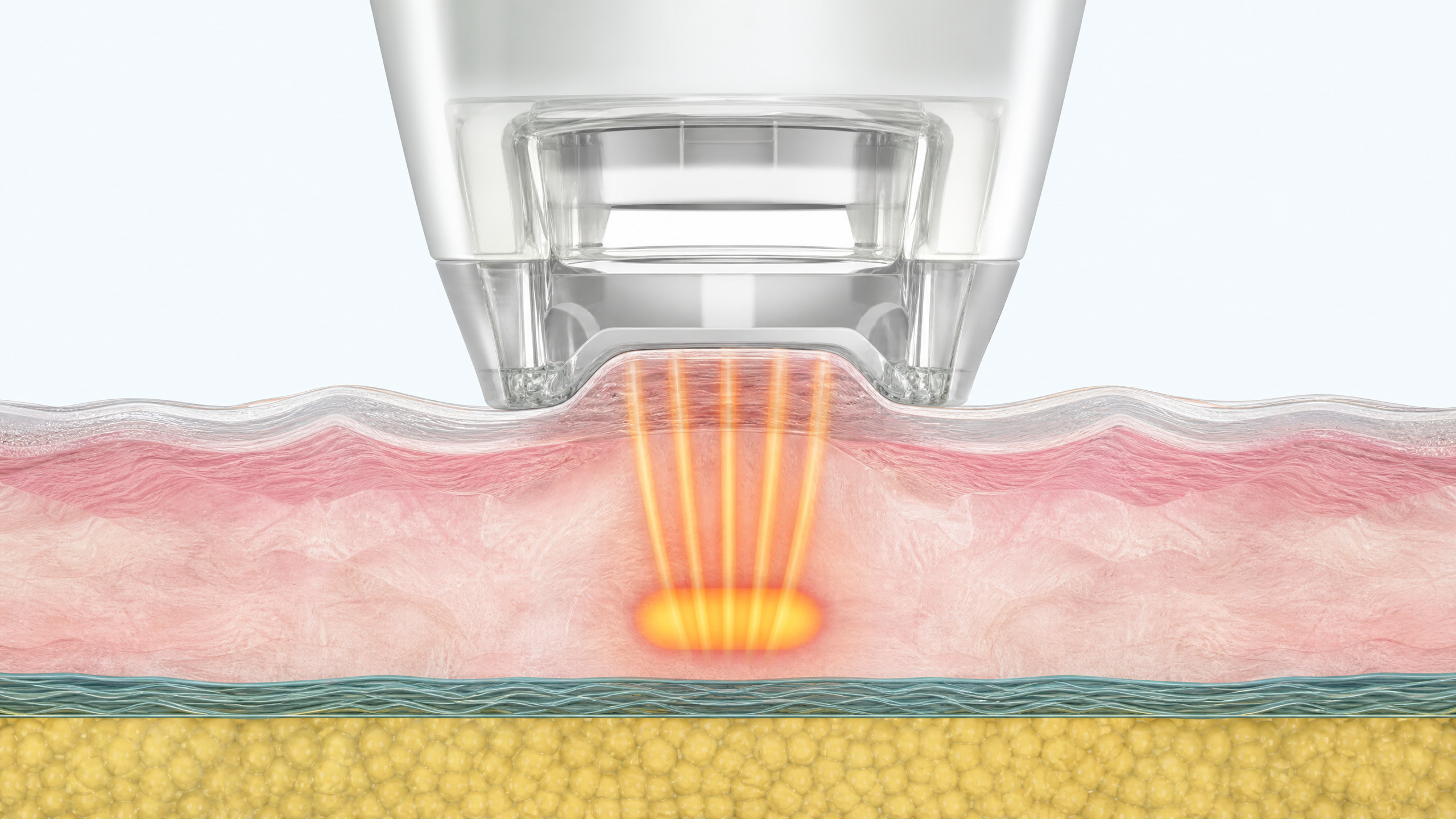 Illustration of focused ultrasound energy used at selected skin depths
