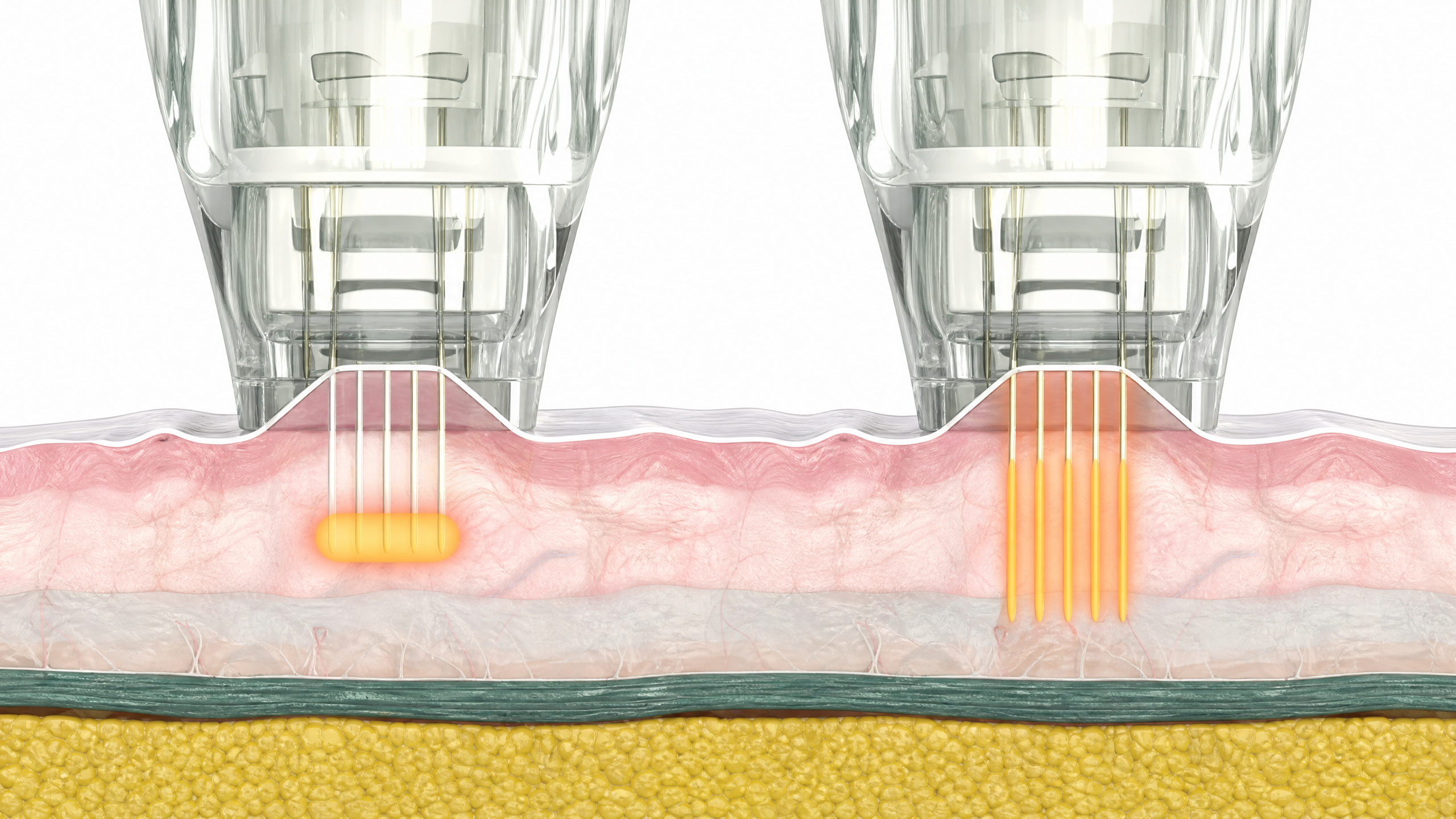 Illustration of RF Microneedling needles at selected skin depths