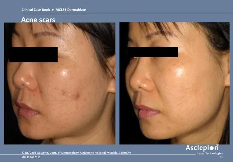 Acne Scar Removal in KL: Pico Laser vs CO2 Laser — Which Is Right for You? - Medicyto Clinic aesthetic treatment blog