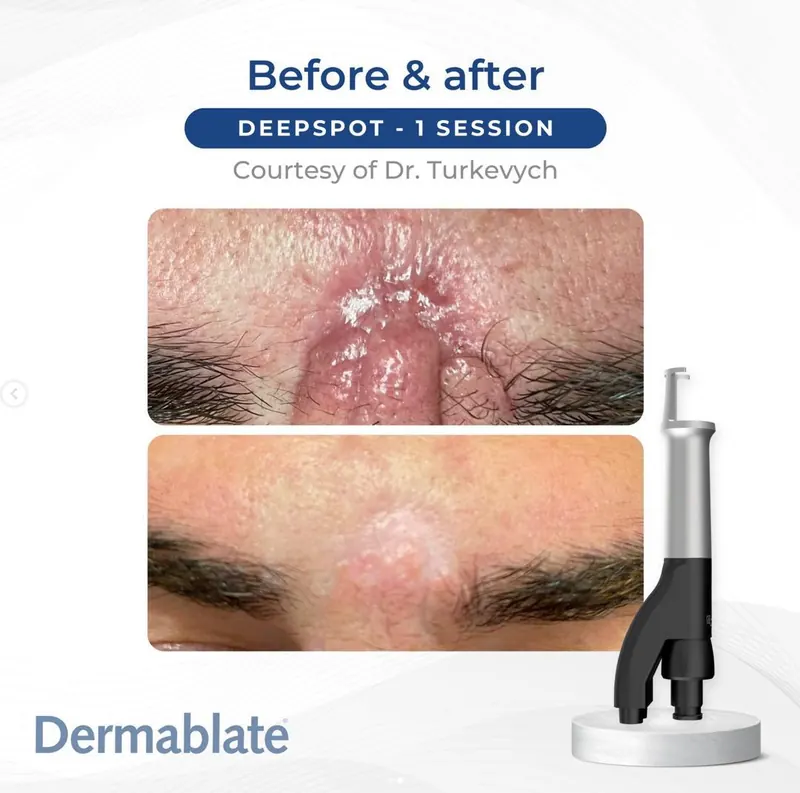Deep spot treatment with Dermablate cold mode - rapid improvement after 1 session