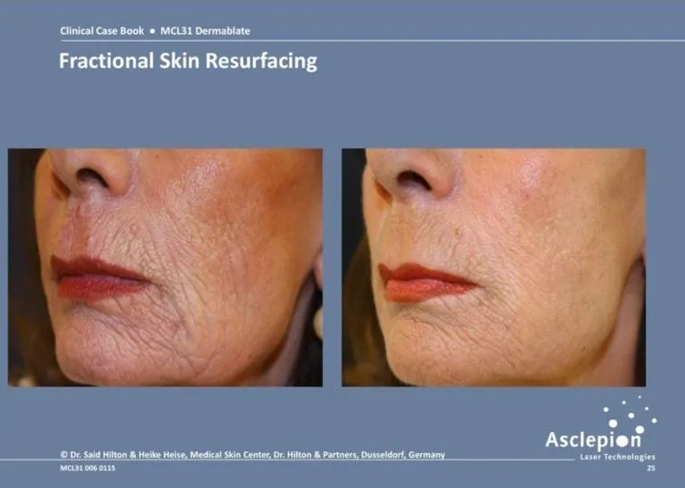 Fractional skin resurfacing with Dermablate - improved texture and clarity