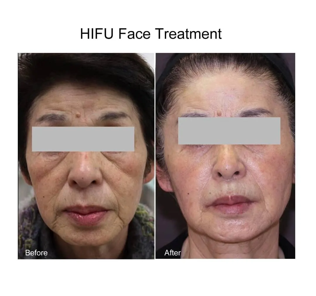 Before treatment photo - HIFU Face Lifting & Skin Tightening - Real Patient Results at Medicyto Clinic